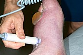 Checking foot pulse in arterial disease