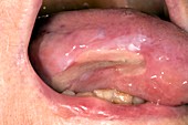 Tongue ulceration