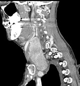 CT scan of thyroid goitre