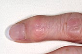 Osteoarthritis of the finger