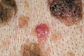 Skin cancer and seborrhoeic warts