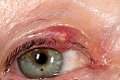 Infected eyelid cyst