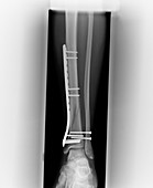 X-ray of fractured tibia and fibula