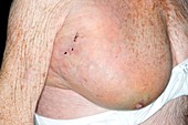 Seroma after breast surgery