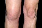 Knee swelling