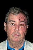 Shingles rash on the face