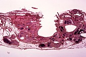 Chronic pancreatitis,light micrograph