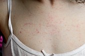 Eczema on a child's chest