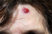 Cancerous nodule on the head