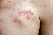 Psoriasis at pacemaker site