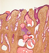 Uterine cancer,light micrograph
