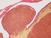 Plasmacytoma,light micrograph