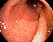 Colonic polyp,endoscope view