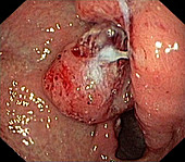 Stomach cancer,endoscope view