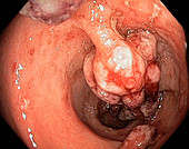 Crohn's disease,endoscope view