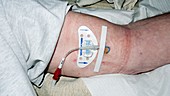 Catheter in arm of cancer patient