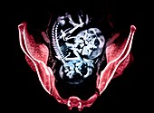Twin foetuses,CT scan