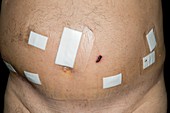 Abdomen after robot-assisted surgery