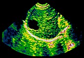 Liver cyst,ultrasound
