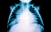 Hiatus hernia in a child,X-ray