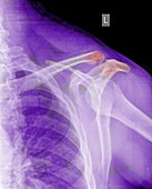 fractured clavicle