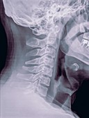 Cervical spine x-ray