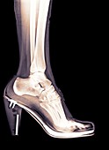 high heel shoe X-ray
