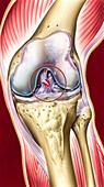 Cruciate ligament knee injury,artwork