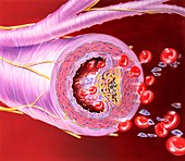 Atherosclerosis of artery,artwork