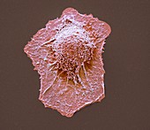 Lung cancer cell,SEM