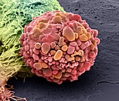 Brain cancer cell,SEM