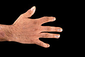 Psoriatic arthritis