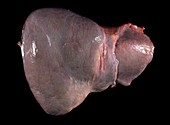 Liver,pathological specimen