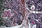 Pancreas in cystic fibrosis,micrograph