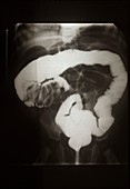 Intussusception of the intestines