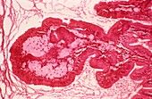 Gallbladder cholesterolosis,micrograph