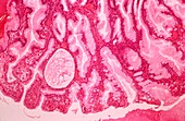 Stomach polyp,light micrograph