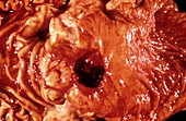 Intestinal ulcer