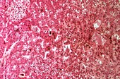 Autoimmune hepatitis,light micrograph