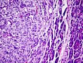 Secondary pancreatic cancer,micrograph