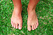 Chikungunya patient's feet