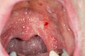 Drug-induced oral ulceration and thrush