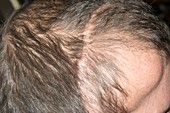 Surgical scar on scalp