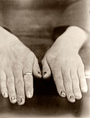 Fingernail loss due to syphilis