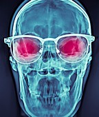 Skull with glasses,X-ray