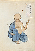 Burn scar contracture,19th-century Japan