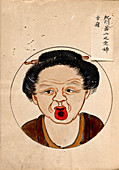 Tongue cancer patient,19th-century Japan