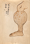 Swollen lower leg,19th-century Japan
