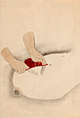 Breast cancer surgery,19th-century Japan
