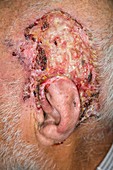 Basal cell carcinoma